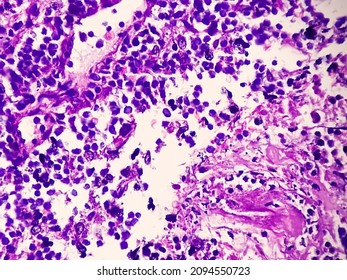 Tongue With Mandible Cancer, Oral Cancer, Invasive Squamous Cell Carcinoma, Grade-II. Lymphovascular Invasion Present, Microscopic View.