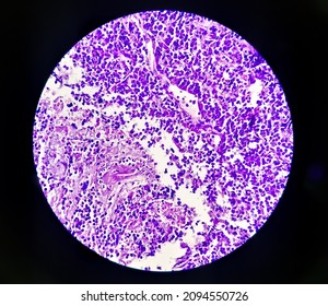 Tongue With Mandible Cancer, Oral Cancer, Invasive Squamous Cell Carcinoma, Grade-II. Lymphovascular Invasion Present, Microscopic View.