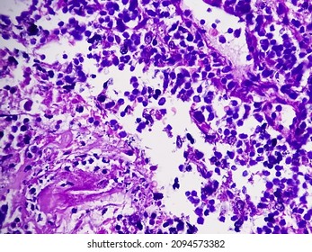 Tongue With Mandible Cancer, Oral Cancer, Invasive Squamous Cell Carcinoma, Grade-II. Lymphovascular Invasion Present, Microscopic View.