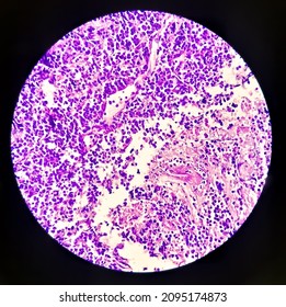 Tongue With Mandible Cancer, Oral Cancer, Invasive Squamous Cell Carcinoma, Grade-II. Lymphovascular Invasion Present, Microscopic View.