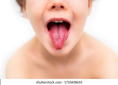 Tongue And Mouth Of A Child During Scarlet Fever