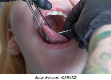 Tongue Piercing Operation