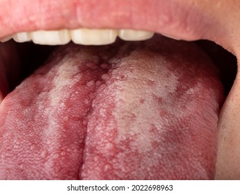 tongue with stomatitis close up, oral cancer. - Powered by Shutterstock