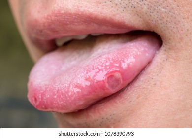 tongue with ulcers of adult man - Shutterstock ID 1078390793