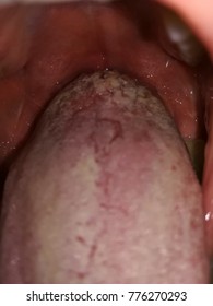 wart on a tongue papilloma meaning in medical terms