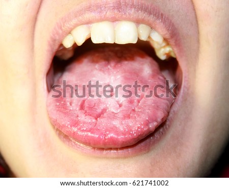 The tongue is in a white raid. Candidiasis in the tongue.