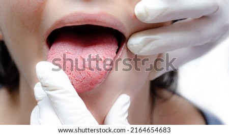 Tongue of a young Caucasian woman with benign migratory glossitis, held by a doctor wearing white gloves. Tongue with candidiasis. Cracks in the tongue.