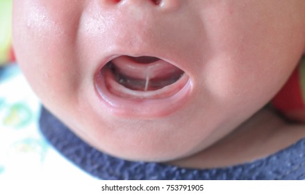 Tongue-tie patient , baby health problem no.1 , baby show tongue and gum