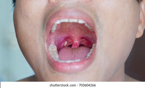 10,419 Tonsillitis Images, Stock Photos & Vectors | Shutterstock