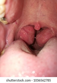 Tonsil Stone Is Seen Inside A Mouth Of A Tonsillitis Patient