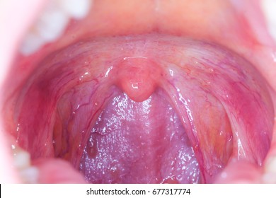 Tonsilitis Infection Throat.macro Opened Mouth Throat  Tonsil