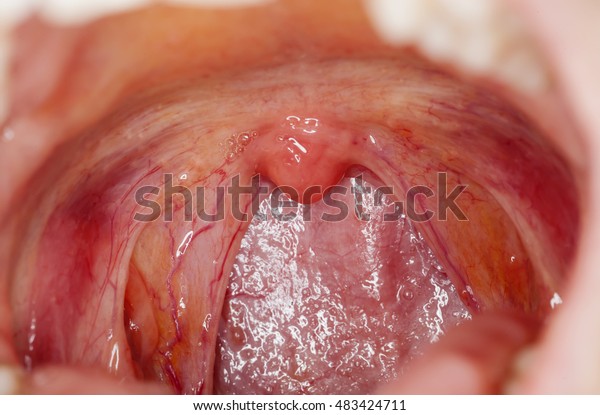 Tonsilitis Infection Throatmacro Opened Mouth Throat Stock Photo Edit