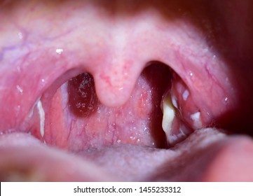 Tonsillitis. Pus On The Tonsils