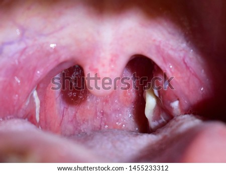 tonsillitis. Pus on the tonsils