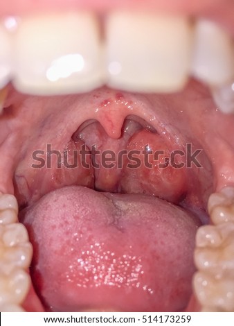 Tonsils swollen due to inflammation in patient