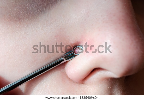 皮膚の黒い斑点やニキビを除去するためのツール 大きな穴と黒い点を持つ鼻 洗顔 の写真素材 今すぐ編集