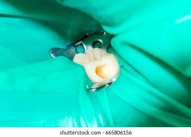 Tooth Cavity Caries Treatment Isolating Cofferdam Dissection