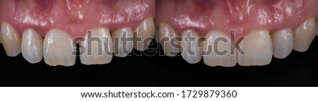 Tooth coloured fillings to close space in the front teeth, before and after.