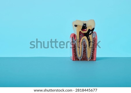 Tooth cross section anatomical model demonstrating deep caries decay. Diagnostics of painful pulpitis and periodontitis.