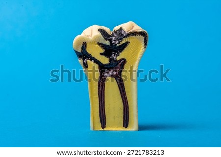 Tooth cross section showing severe decay and dental pulpitis