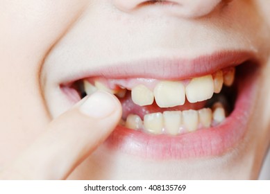 tooth decay - Powered by Shutterstock