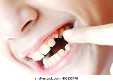 tooth decay - Powered by Shutterstock