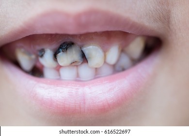 子供 虫歯 の写真素材 画像 写真 Shutterstock