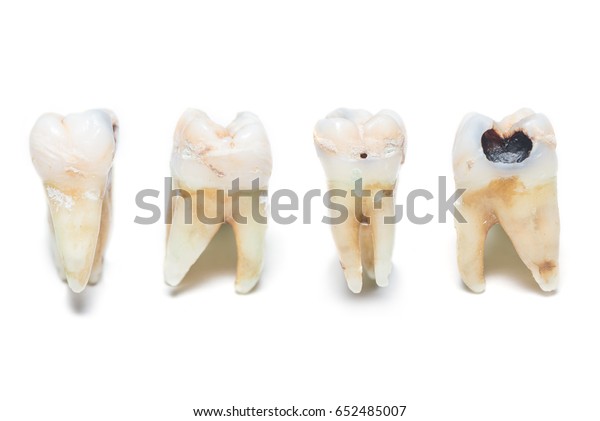 Tooth Decay 4 Sides View Isolated Stock Photo 652485007 | Shutterstock