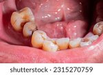 Tooth decay, broken teeth, oral health Poor dental health. Oral health problems. Loose, yellow teeth, plaque and tartar at the edge of the gums