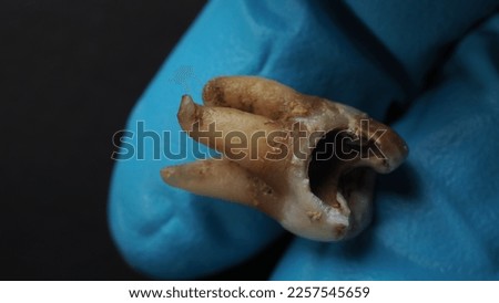 Tooth decay and dentist hand with glove and black background. Macro shot of a decayed teeth till root after extraction of dentist. Real tooth anatomy due lack of dental care. Top view of caries teeth
