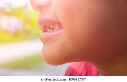 Tooth Decay In The Mouth Of A Child.