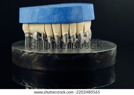 Tooth dental crowns created on 3d printer for metal. Gypsum model on a printed metal frame