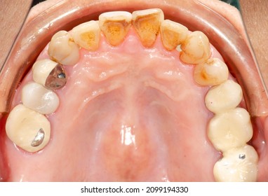 Tooth Erosion On Palatal Aspects Of Front Teeth Because Of Often Vomiting