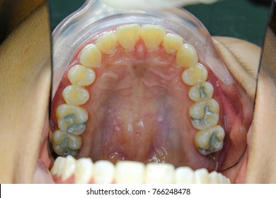 Tooth Filling With Amalgam