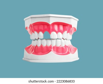 Tooth loss concept. Missing teeth in jaw model on background. Dentistry problems. Gap, absence. High quality photo - Shutterstock ID 2223086833