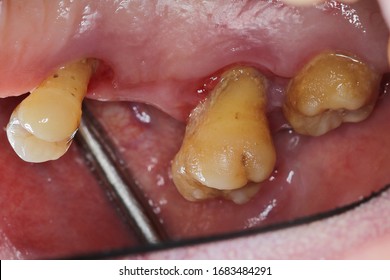 Tooth migration due to periodontitis ; Migrated tooth is defined as the movement of teeth into altered positions in relation to the basal bone of the alveolar process.