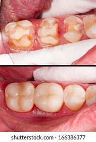 Tooth Restoration Before And After Dental Treatment