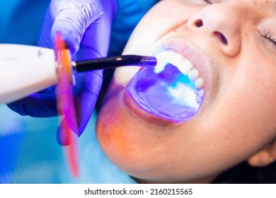 Tooth restoration with filling and polymerization lamp. Dental curing light setting composite resins. - Shutterstock ID 2160215565