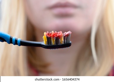 Toothbrush With Blood Closeup. A Woman Discovered Bleeding Gums While Brushing Her Teeth. Gingivitis Or Periodontal Disease