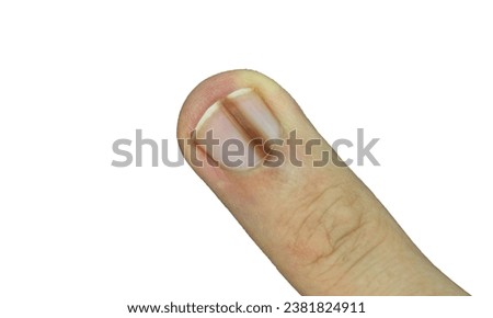 Top closeup view of male hand with brown line on one of the finger's nail better known as melanonychia (nail pigmentation) on white background with copy space