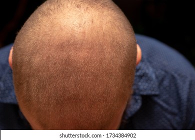 Top Down View Of A Man's Bald Head, Receeded Hairline. Isolated On Black Background