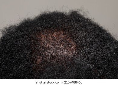 Top view american head top hair detail close-up show hair-loss impact. Hair loss treatment concept - Powered by Shutterstock