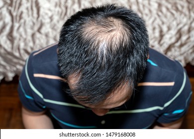 Top View Of Bald Head Or Hair Loss Problem.