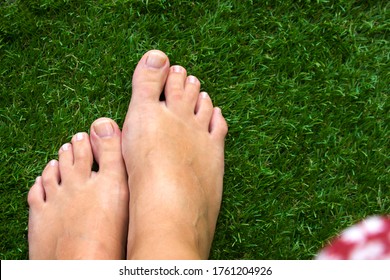 Draufsicht auf weibliche Beine mit geschmolzenen mittleren Zehen auf grünem Grashintergrund. Zehen-genetische Störungen und Syndrom, Syndrom der Zehen. Spezielle Menschen.