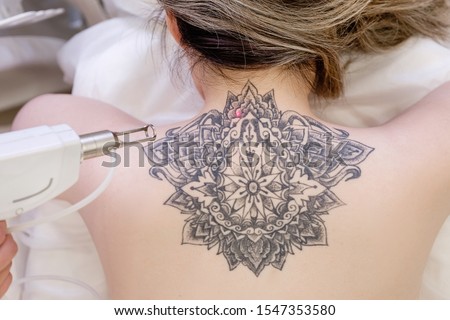 Top view hand of a beautician holds a laser device over a tattooed back of a girl to remove an unwanted tattoo. Concept of erasing tattoos as an expensive procedure in beauty parlor