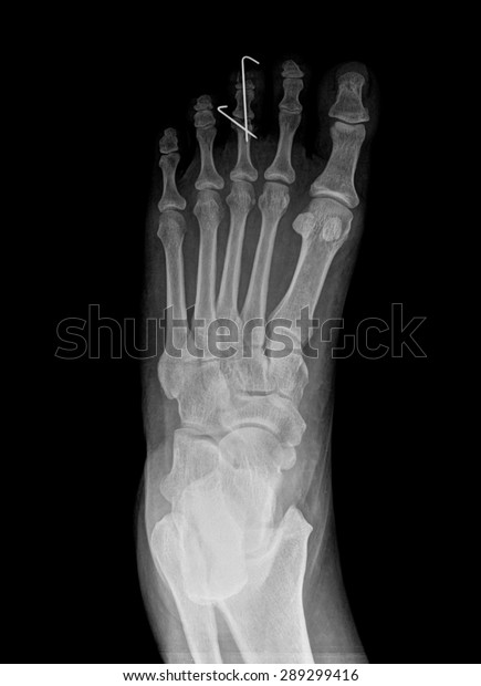 Top View Humans Feet Bones Under Stock Photo 289299416 | Shutterstock