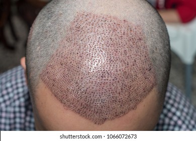 Top View Of A Man's Head With Hair Transplant Surgery. Bald Head Of Hair Loss Treatment.