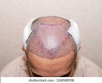 Top View Of A Man's Head With Hair Transplant Surgery. Bald Head Of Hair Loss Treatment.