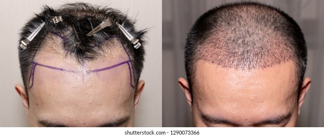 Top View Of A Man's Head With Hair Transplant Surgery With A Receding Hair Line. - Before And After Bald Head Of Hair Loss Treatment.