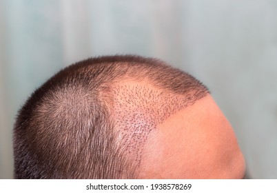 Top View Of A Man's Head With Hair Transplant Surgery With A Receding Hair Line. -  After Bald Head Of Hair Loss Treatment.